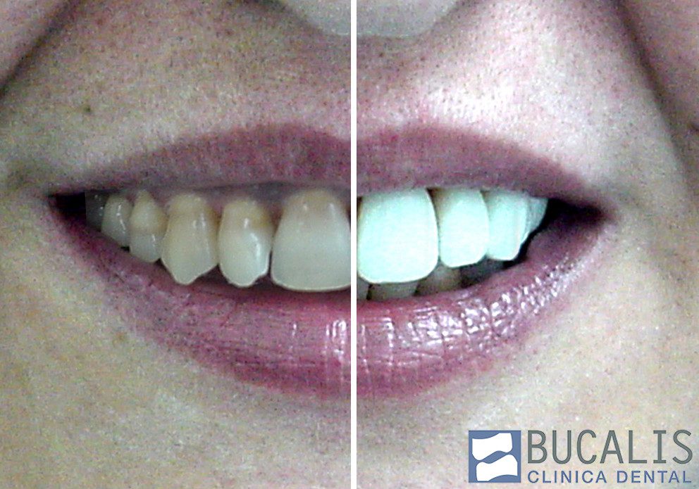 carillas-dentales-antes-despues