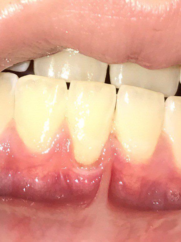 Recesión gingival, Oliver Coll