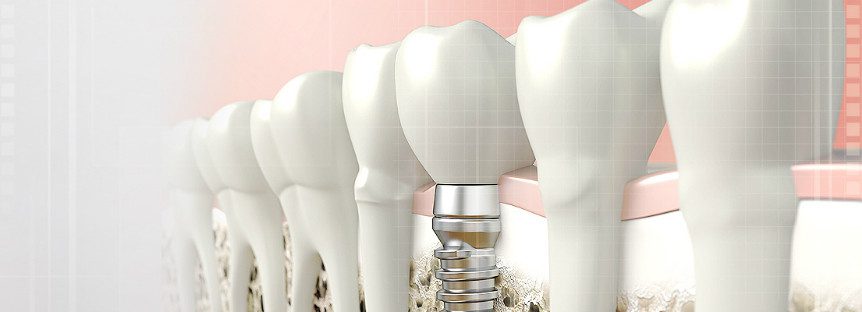 Implantes dentales en Mataró