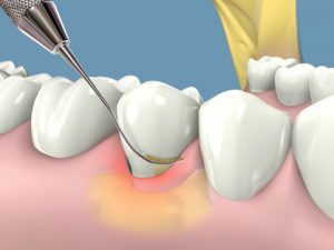 Tratamiento de periodoncia, cómo se realiza