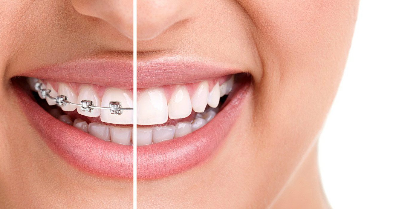 Ortodoncia con Brackets y Ortodoncia Invisible, Oliver Coll
