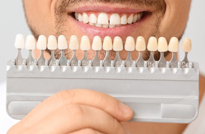 Blanqueamiento dental en Mataró