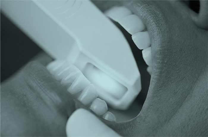 Escáner Intraoral en Oliver Coll