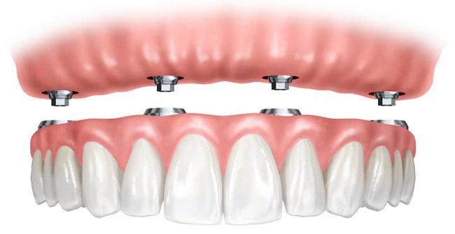 Implantes dentales en Mataró