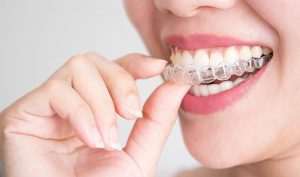 Alinear los dientes sin brackets