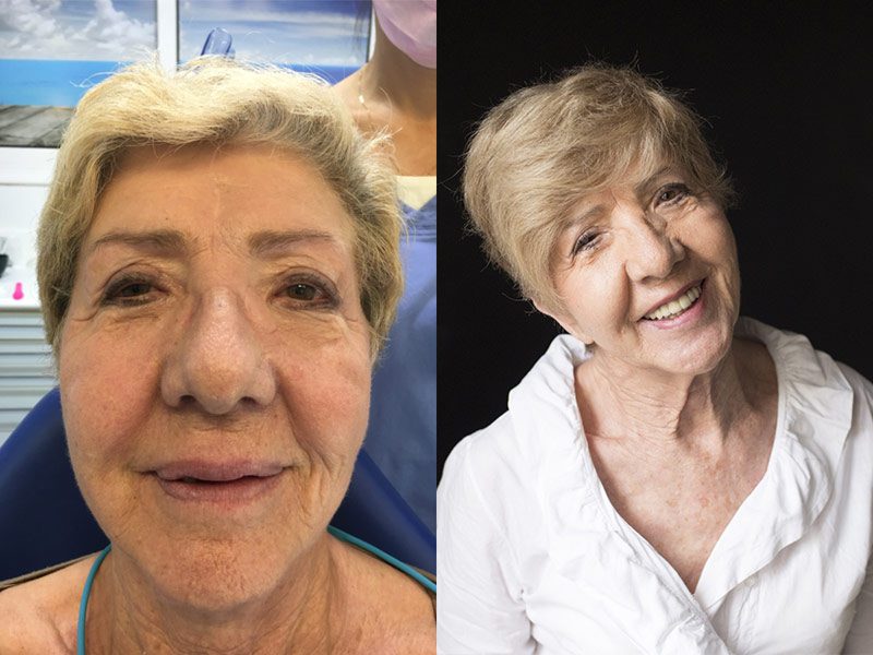 Rehabilitación completa con implantes dentales