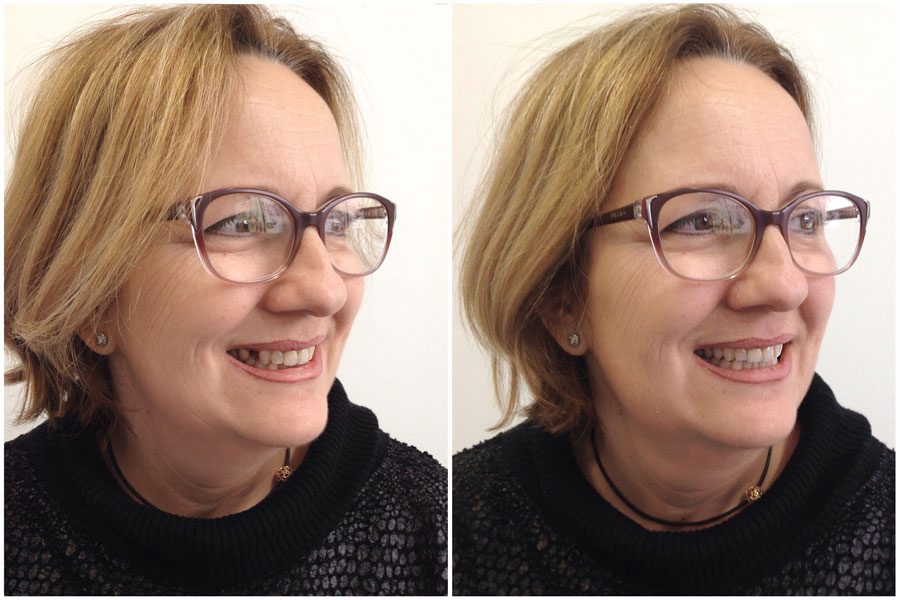 antes-depues-implante-dental