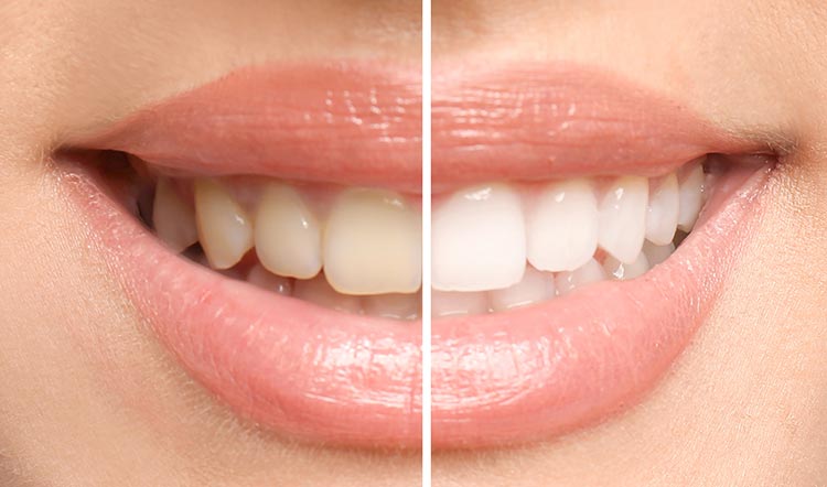mantener-resultados-blanqueamiento-dental