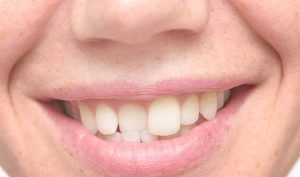 Ortodoncia para corregir un solo diente