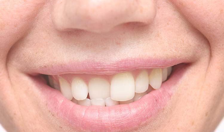 Ortodoncia para corregir un solo diente