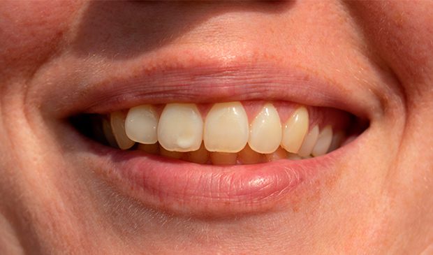 Las manchas en los dientes impiden que luzcas la mejor de tus sonrisas.