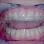 Detalles del adjunto Ferula-descarga-para-tratamiento-bruxismo-nocturno-scaled.jpeg 27 de agosto de 2025 398 KB 2560 por 1696 píxeles Imagen original: Ferula-descarga-para-tratamiento-bruxismo-nocturno.jpeg Editar la imagen Borrar permanentemente WP Rocket recommends you to optimize your images for even better website performance. Install Imagify Plugin Texto alternativo Aprende cómo describir el propósito de la imagen(abre en una nueva pestaña). Déjalo vacío si la imagen es puramente decorativa.Título Férula descarga para tratamiento bruxismo nocturno Leyenda Descripción URL del archivo: https://olivercoll.staging.dissenyweb.com/wp-content/uploads/2022/12/Ferula-descarga-para-tratamiento-bruxismo-nocturno-scaled.jpeg Copiar la URL al portapapeles Smush 8 imágenes reducidas en 238,4 KB (9.7%) Tamaño de la imagen principal: 368,31 KB Ver estadíticas Los campos obligatorios están marcados con * Sustituir medios Subir nuevo archivo Para reemplazar el archivo actual haz clic en el enlace y sube un archivo de reemplazo. Eliminar fondo Eliminar fondo Para eliminar el fondo haz clic en el enlace. Ajustes de visualización de adjuntos Alineación Centrar Enlazado a Ninguna Tamaño Miniatura – 150 × 150 Acciones de los medios seleccionados 1 elemento seleccionado Borrar Insertar en la entrada Ningún archivo seleccionado