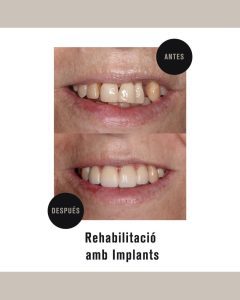 implantes dentales unitarios