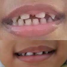 tratameinto agenesia dental