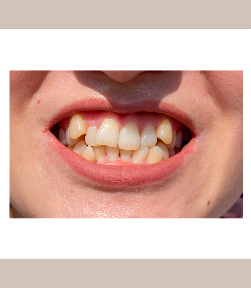 Invisalign_comprehensive_4