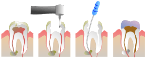 endodoncia