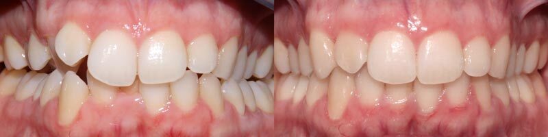 Mordida cruzada posterior