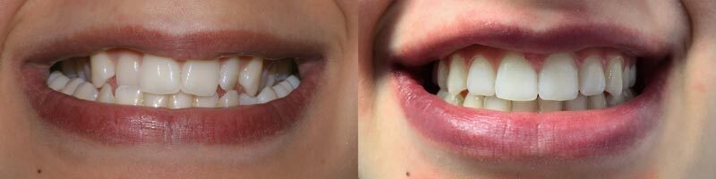 Mordida cruzada bilateral