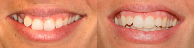 Mordida cruzada posterior 2