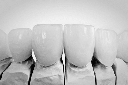 Carillas dentales en Mataró