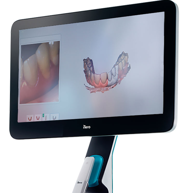 Escaner_intraoral_itero