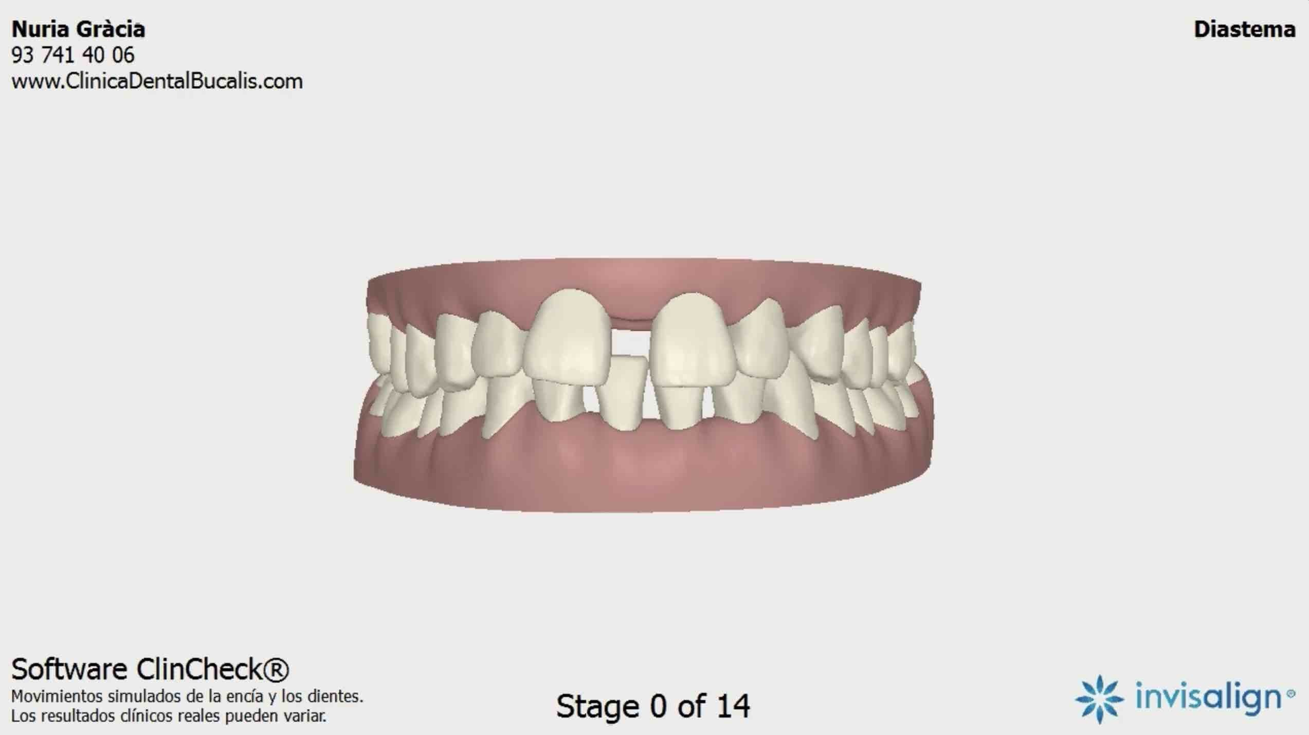 Invisalign ClinCheck
