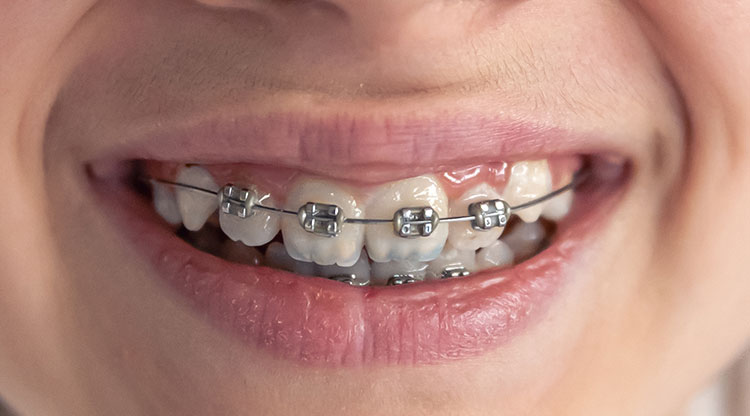 Ortodoncia_infantil