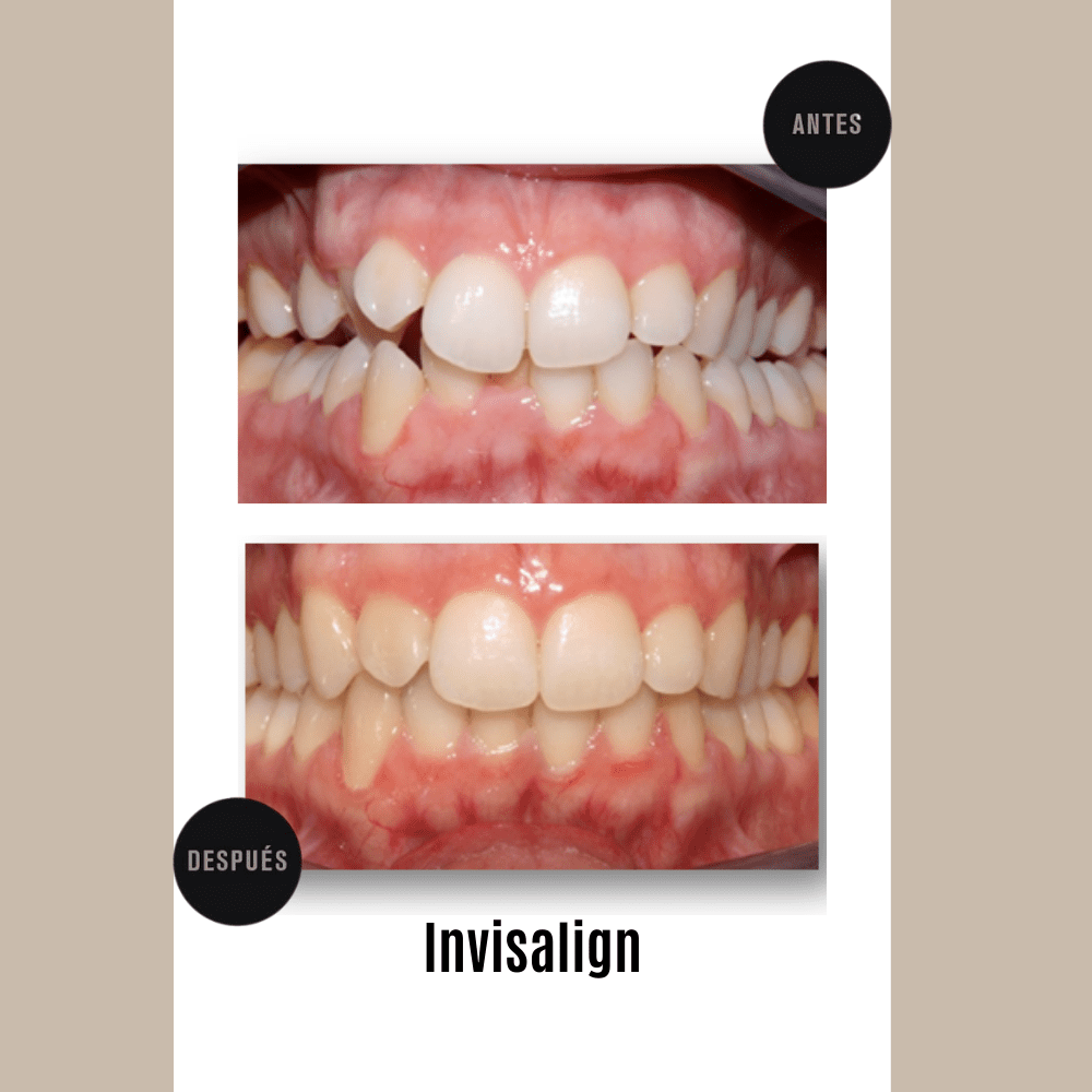 Resultados-ortodonocia-invisaling (1)