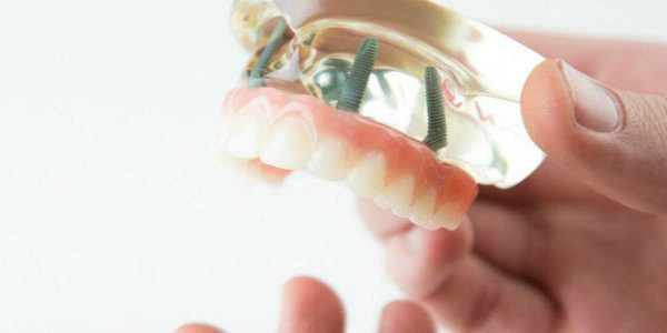 All on 4, implantes dentales en Mataró