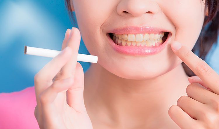 blanqueamiento-dental-fumadores