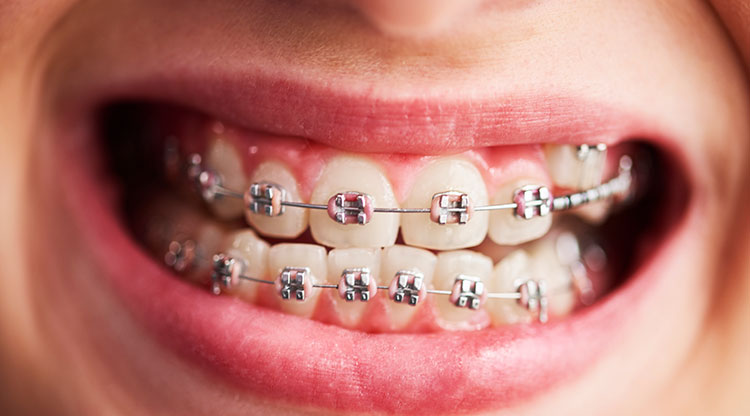brackets