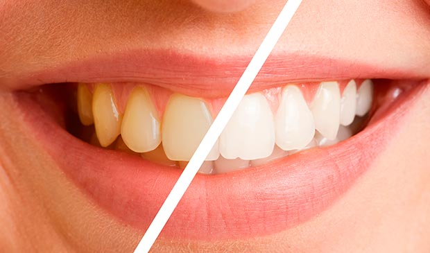 cambio-dientes-amarillos
