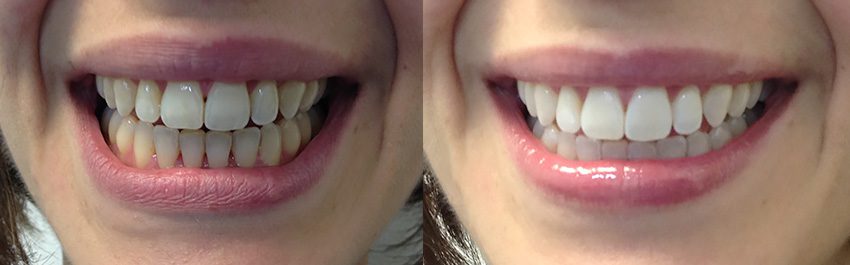 Caso real blanqueamiento efectivo en Mataró