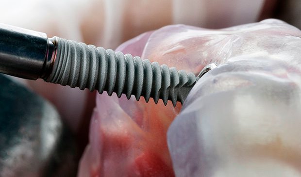 Cirugía colocación implantes dentales