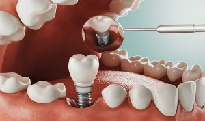 Proceso para colocar implantes dentales