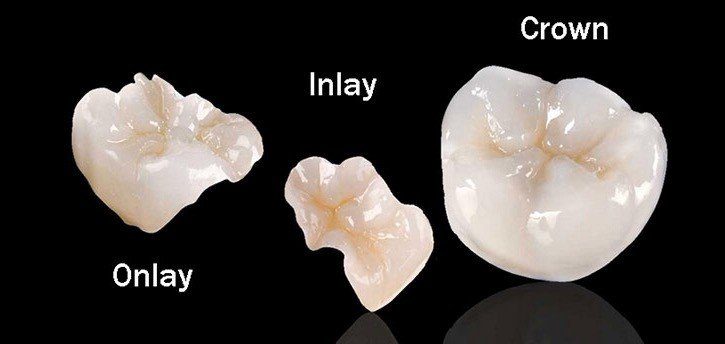 Onlay Crown San Antonio Dentist