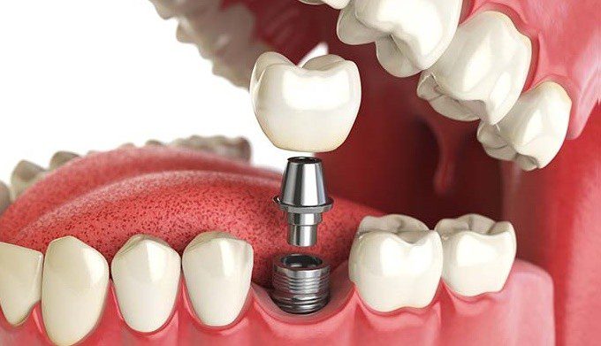 Implantes sin cirugía, Oliver Coll