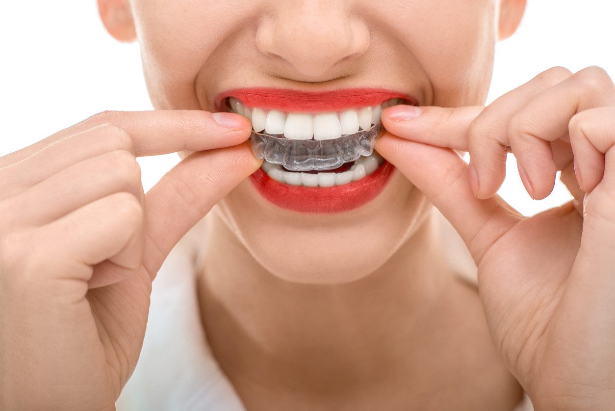 Invisalign, alineadores invisibles