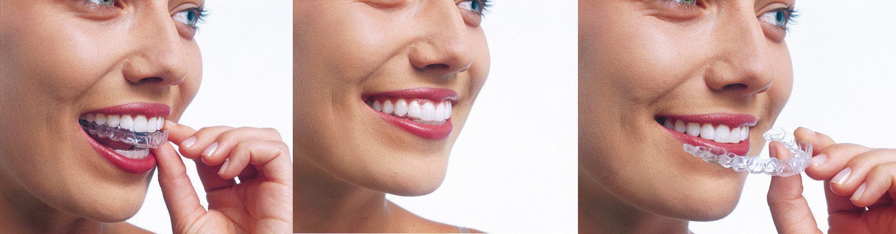invislign-ortodoncia-invisible