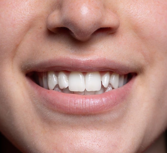 procedimiento-contorneado-dental