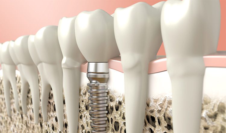 Rechazo de un implante dental