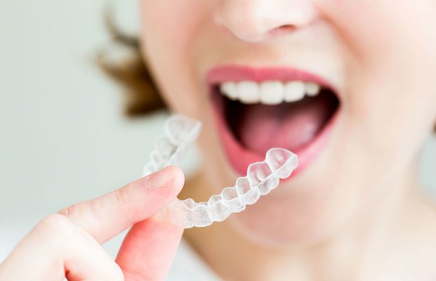 Qué es Invisalign, Oliver Coll