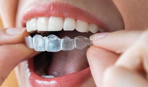 Alineadores para solucionar dientes torcidos