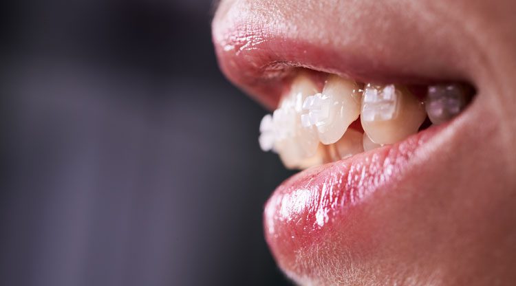 tratamiento-ortodoncia-brackets-esteticos-mataro