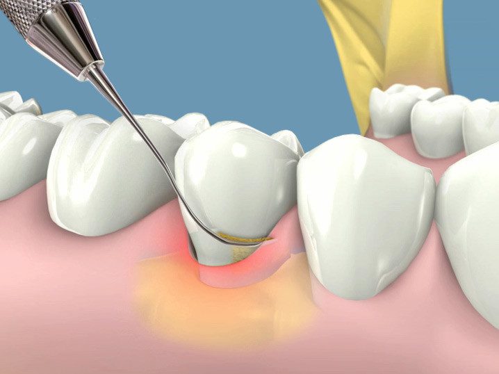 Tratamiento de periodoncia, cómo se realiza